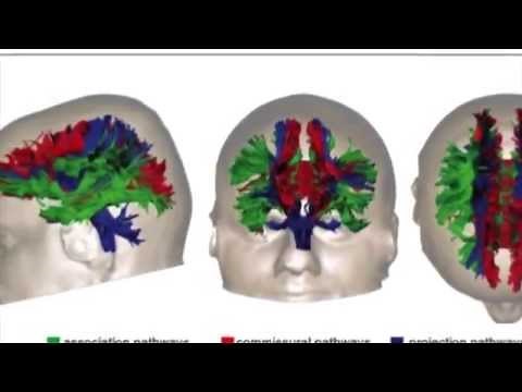 Brain Injury & Diffusion Tensor Imaging -DTI
