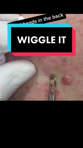 Gotta wiggle that comedone extractor! #drpimplepopper #SLMDskincare #learnontiktok