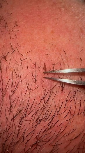 5.8K views · 29 reactions | Plucking off my husbands beard pili multigemini hair #pick #plucking #asmr #beard8 | Daisy Williamson | Facebook