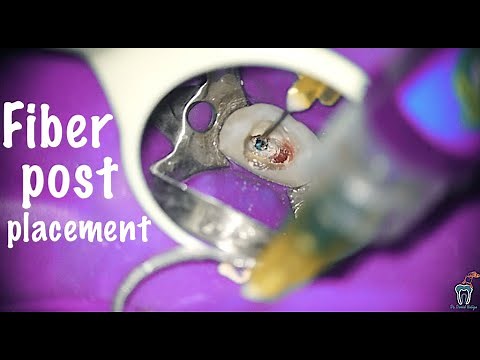 Cum se pune un pivot de fibra de sticla - Fiber post placement