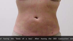 Before and After Awake Liposuction