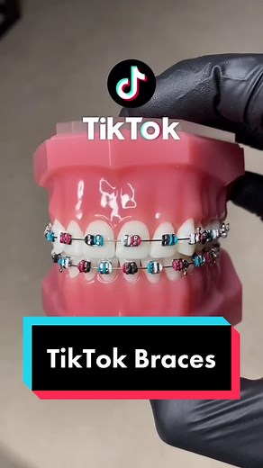 TikTok Braces: Which Would You Wear?