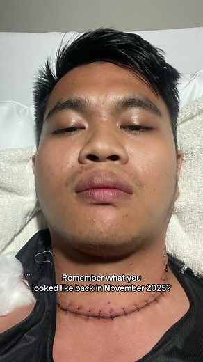 Thyroid Cancer Journey: Overcoming Challenges 🤍