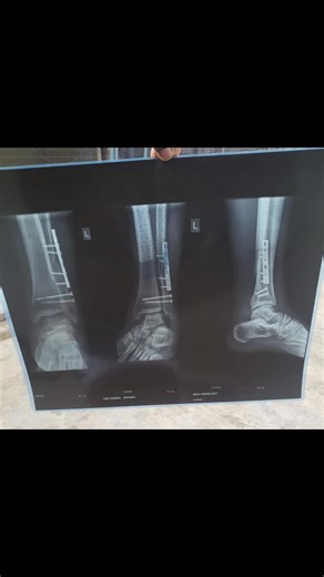 Ankle Fracture Treatment and Rehab Strategies