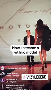 I did it ❤️ #vitiligo #vitiligomodel #inspire | Faizy Legend