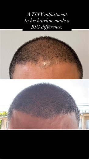 Check out this before & after — just a few subtle adjustments to the hairline, and the difference is huge. It’s all about enhancing what’s already there for a natural, refined look. Sometimes, less really is more! #HairlineTransformation #FUEresults #SubtleChangesBigImpact #NaturalLook | Samson Hair Restoration | Facebook