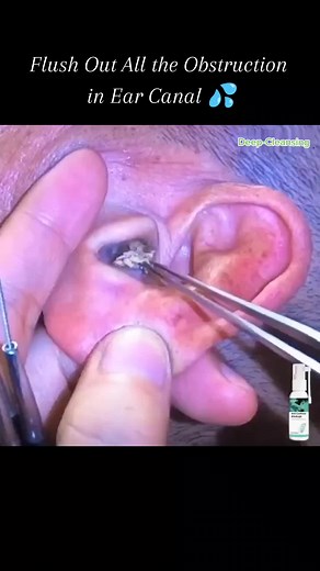I've had ear wax buildup for years and have tried several different removal techniques, but nothing has worked as well as this spray. I followed the instructions and sprayed the solution into my ear, waited a few minutes, and then flushed it out with warm water. The amount of ear wax that came out was astounding, and I could immediately feel a difference in my hearing 👂✨ #allergytreatment #tiktokhealth #viral #fyp #foryoupage #health #care #bodycare #bodycareroutine