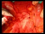 Open Right Hemicolectomy – Technical Principles - Operation No 1B - Part 5 • Video • MEDtube.net