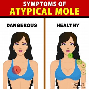 144K views · 1.6K reactions | Symptoms of Atypical Mole | Health+ | Facebook