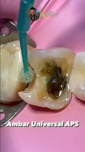 Step 2: Immediate Dentin Sealing (IDS) || Bonding protocol