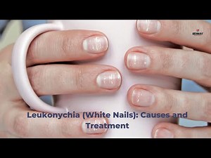 Leukonychia (White Nails): Causes and Treatment