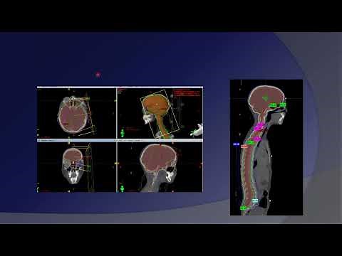 Treatment Planning of CSI