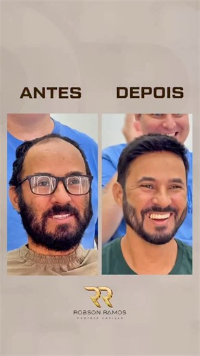 Robson Ramos Protese Capilar on Instagram: "😱 Quando a transformação é bem feita, o resultado fala sozinho. O espelho mostra mais do que um novo visual — mostra confiança, leveza e a sensação de “agora sim”. Aqui, cada detalhe é pensado pra você se sentir bem todos os dias. 💙 💻 rrprotesecapilar.com.br 📞 (19) 99664-3334"