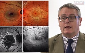 【中英双字】【OCT解读 实战Case】OCT: Interpreting the image