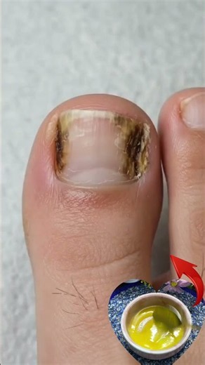 ✨ Repair damaged nails naturally! 🌿💅 Try this simple home remedy to help your nails look stronger