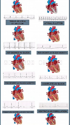 Abdallah Othman | 🌟 Hey amazing followers! I'm thrilled to bring back our loved "In-Depth Visual Guide to Cardiac Arrhythmias🫀📊" by @abdullah_89othman! Dive... | Instagram