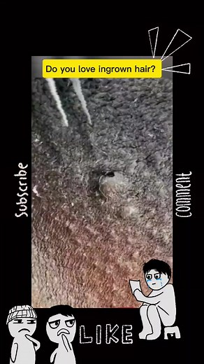 Do you love ingrown hair?? #ingrownhairremovalll #skincare #viral #satisfyingg #ingrownhairrr