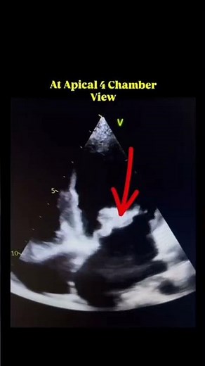 Learn to identify Mitral Valve Prolapse like a pro with @echo_tips2128.#echocardiography#heart echo