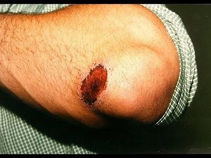 DermTV - What is a Scab [DermTV.com Epi #365]