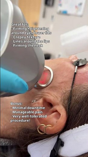 A CO2 laser with minimal downtime? Yes please 🙌