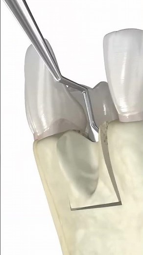Dental bone graft: 3d animation #medicalanimation #dentalprocedure