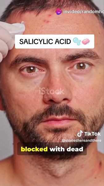 Source: HealthLine, WebMD, Medical News Today When pores become blocked with dead skin cells and oil, blackheads (open clogged pores), whiteheads (closed clogged pores), or pimples can form. Salicylic acid, one of the safest solutions for pores clogged with oil, penetrates the skin and helps to dissolve the dead skin cells causing the blockages. It may take a few weeks of consistent use to see full results. If there’s no improvement after six weeks, consult your dermatologist. This medication is