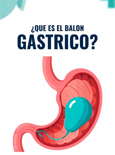 ¿Qué es el procedimiento del balón gástrico #gastricballoon #weightloss #weightlossjourne #health