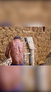 610K views · 6.7K reactions | We’re introduced to Mithun, a young man living with large tumours on his face and body. His courage, resilience, and quiet strength set the stage for a powerful journey that will move you deeply. This is more than a documentary—it’s a window into a life few could imagine. #RealStories #TheBubbleWrapBoy | Banijay Documentaries | Facebook