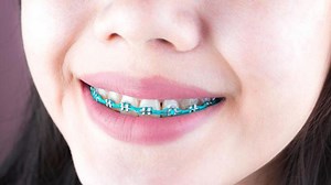 Brackets caseros falsos: estos son sus riesgos para la salud