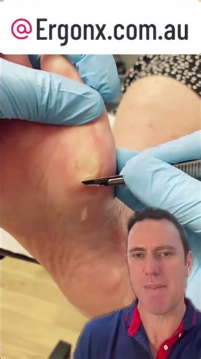 Say Goodbye to Calluses: Podiatrist Guide to Smooth Feet #FootCare #CallusRemoval