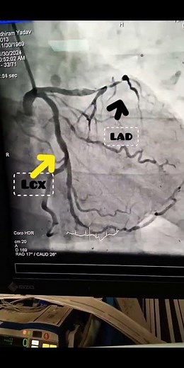 Coronary artery bypass grafting (CABG)