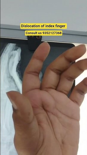 dislocation index finger #postoperative #physiotherapy #finger #thumb #joint #hand #stiffness #ruhs