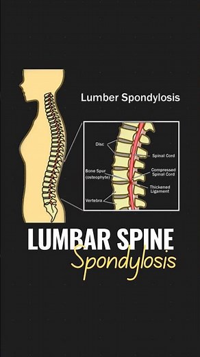 Understanding Lumbar Spine Spondylosis | Causes, Symptoms & Treatment Options | Dr. Vikas Kathuria