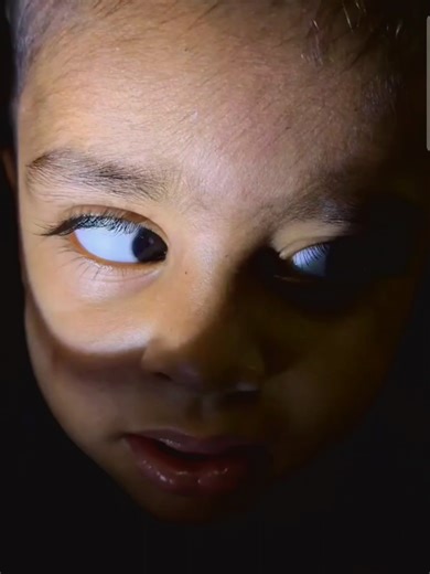 Congenital bilateral cataracts (clouded lenses present at birth in both eyes) and nystagmus (involuntary eye movements) often occur together with the cataracts depriving the developing visual system of clear images leading to poor vision and the development of sensory nystagmus to try and stabilize vision. This combination significantly impacts visual development causing permanent impairment if not treated early though prompt surgery and vision therapy can lead to better outcomes even with nysta