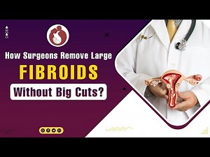 How surgeons remove large fibroids with laparascopy? Fibroid Removal, #FibroidsTreatment