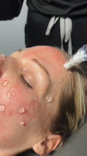 Microneedling Accelerated Serum = next-level collagen stimulation ✨ Creating controlled micro-channels to drive powerful actives deeper for smoother texture, refined pores, and that lit-from-within glow. | VIO Med Spa