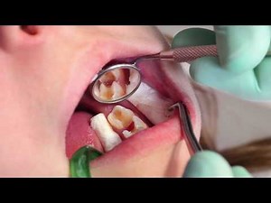 What to do when a tooth has a deep carious lesion