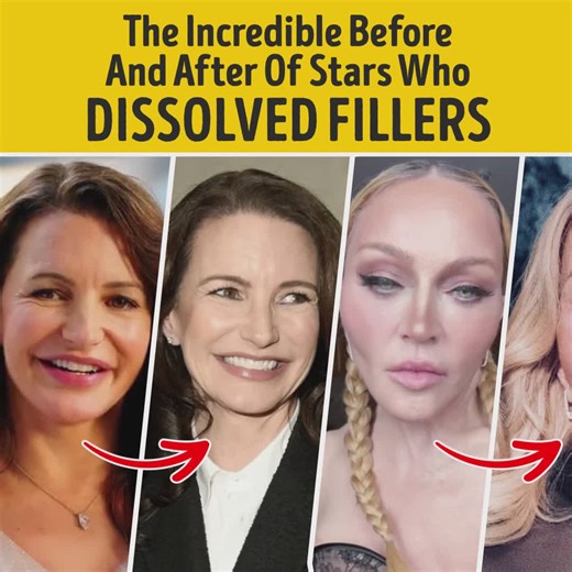 The Incredible Before And After Of Stars Who Dissolved Fillers | Bright Side