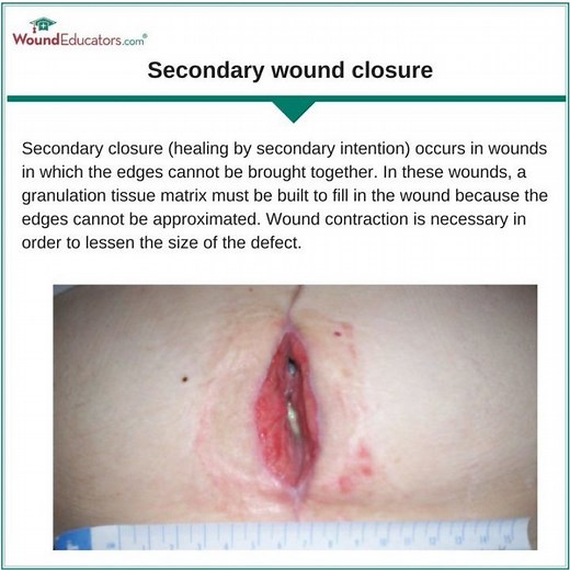 Types of Wound Closure