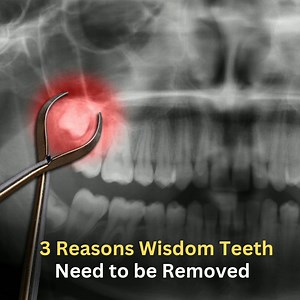 93K views · 829 reactions | This is why dentist remove wisdom tooth | Dental Daily | Facebook