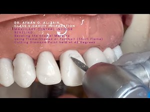 Class V cavity preparation for composite on a maxillary central incisor (#11) - Arabic عربي