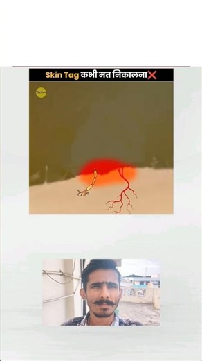 "क्या Skin Tag खतरनाक है? जानिए सच #factsSkinTag #SkinCare #HomeRemedies #skin