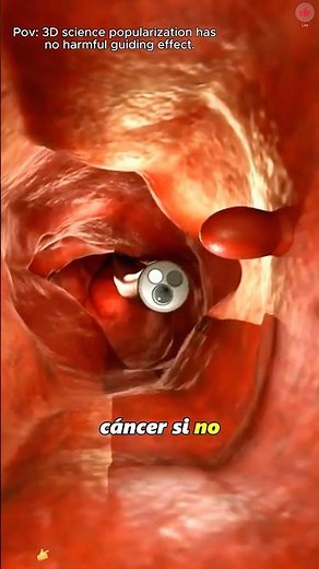 How Colon Polyps Are Removed? (3D Animation)#colonpolypectomy #colonpolyp #colonpolyps #polypectomy