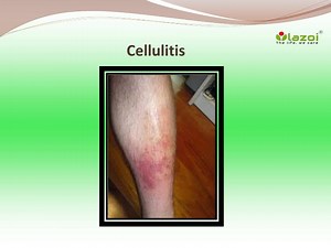Cellulitis: Symptoms, Causes, Diagnosis, Treatment, Prevention and Complications - SlideServe