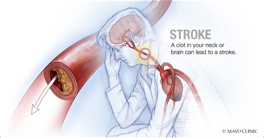 Mayo Clinic Minute: Preventing stroke - Mayo Clinic News Network