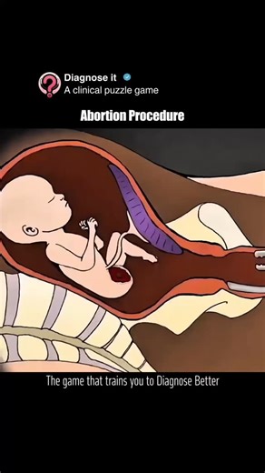 Diagnose it on Instagram: "🩺 Abortion Procedure — Understanding the Medical Process An abortion procedure is a safe, medically guided process used to end a pregnancy when performed by trained healthcare professionals. Depending on the stage of pregnancy, it may be done using medications (medical abortion) or a minor surgical procedure. Both methods are evidence-based, widely practiced, and focused on protecting the patient’s health and safety. Access to accurate information, proper medical care