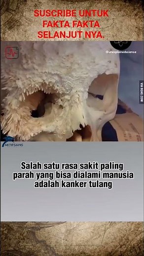 kanker tulang