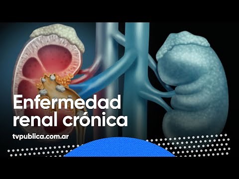 Enfermedad renal crónica: Causas, factores de riesgo y prevención – En Casa Salud