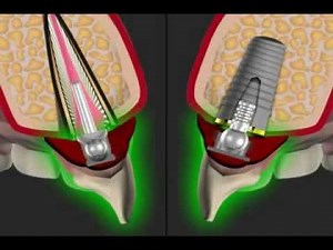 besserer Halt für die Zahnprothese mit dem Kugelanker