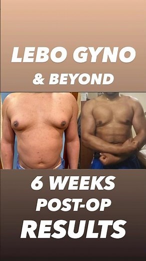 Gynecomastia Surgery 6 Weeks Post-Op | Stunning Before & After Photos